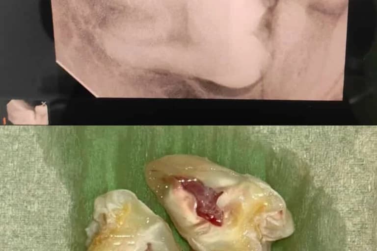 Wisdom tooth removal by surgical extraction.